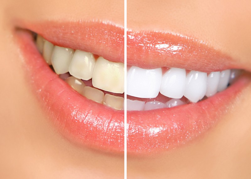 teeth whitening services San Diego and Escondido, CA